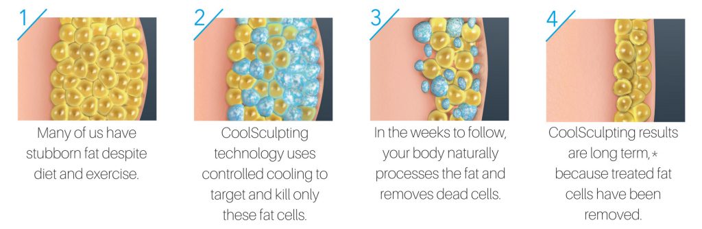 How CoolSculpting Works
